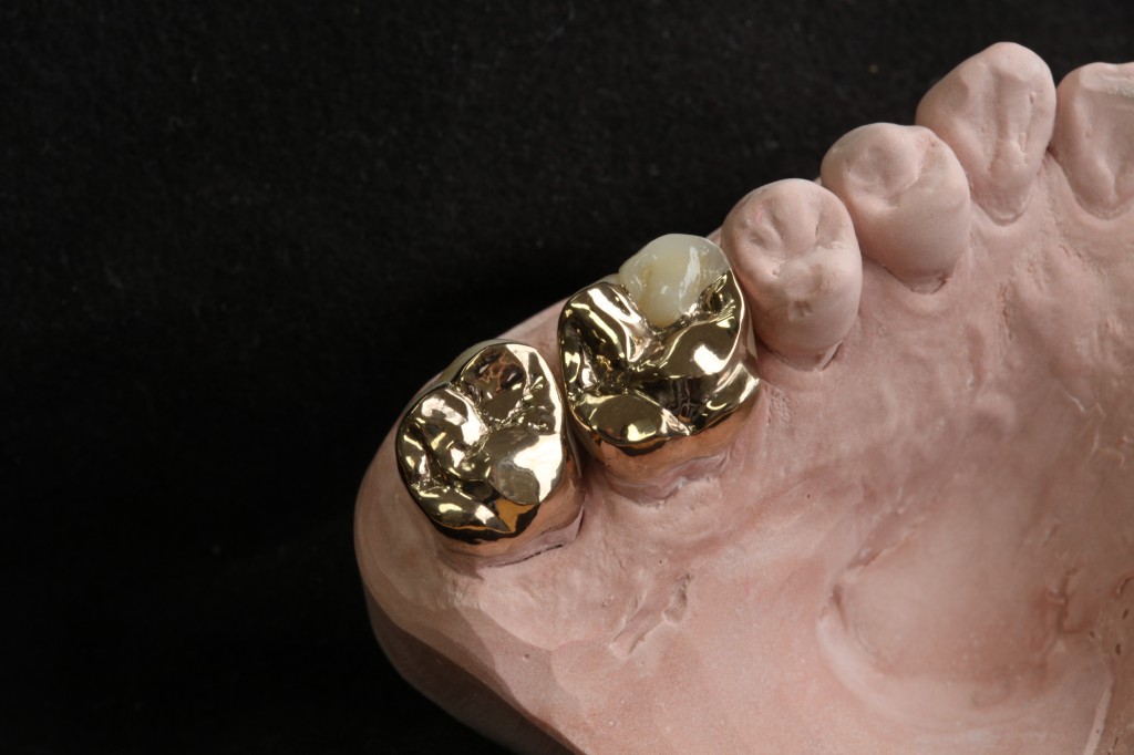 Gold Restorations Mueller's Dental Arts Laboratory