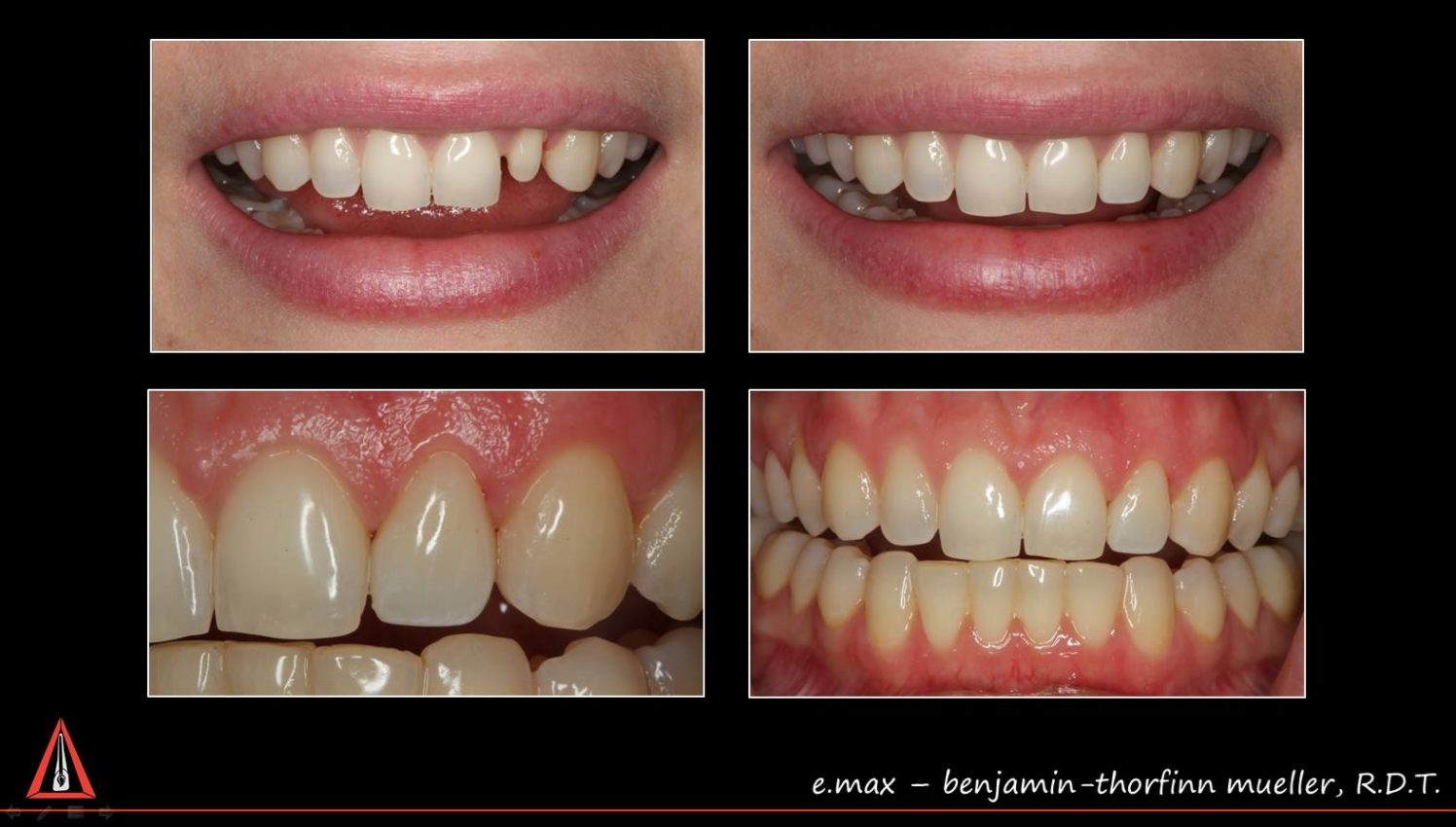 E.MAX Mueller's Dental Arts Laboratory